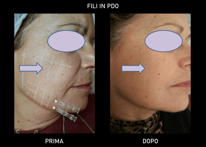 donna prima e dopo del trattamento medico estetico di posizionamento dei fili biostimolanti e di sostegno presso lo studio della dott.ssa Virginia De Simone